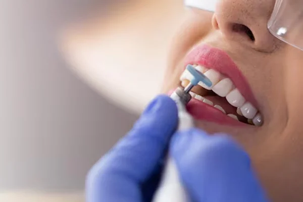 Teeth Cleaning and Polishing