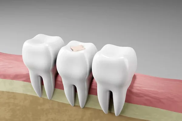 Tooth Fillings