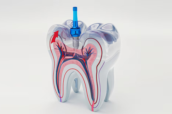 Root Canal Treatment