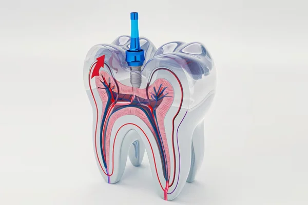 Root Canal Treatment