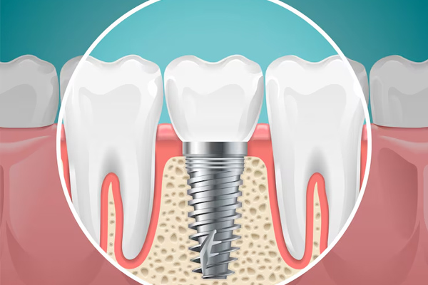 Dental Implants