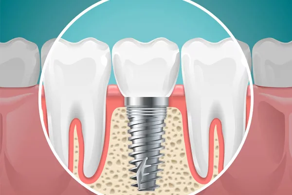 Dental Implants